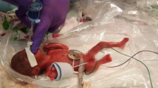 243g의 미숙아로 태어난 세이비는 세계에서 가장 작은 아기로 등록됐다. ⓒSharp Health