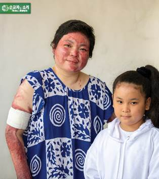 페니는 화상으로 피부가 연약해졌기 때문에 딸을 더 이상 안을 수 없다.