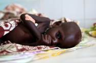 극심한 영양실조로 고통받는 아프리카 아동
