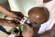 남수단에서 영양실조 검사를 받는 아이. 빨간색 표시는 중증 급성영양실조를 앓고 있음을 나타낸다. ⓒ월드비전