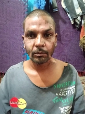 ▲얼굴과 목에 심각한 화상을 입은 자히드 모리스. ⓒCDI-MSN