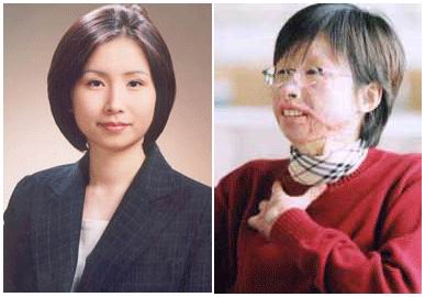 화상 전과 후의 이지선 양. 그녀는 자신이 화상을 입은 2000년 7월 30일을 '두번째 생일'이라고 말한다.