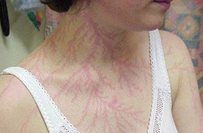 번개를 맞아 몸에 무늬가 생긴 여성